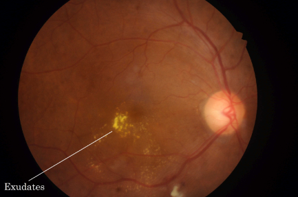 Macular Degeneration Grading project preview